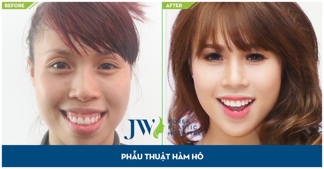 Phẫu thuật hàm hô, móm - cuộc đời nở hoa hay bế tắc? - ảnh 1
