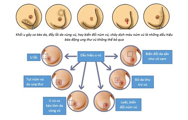 Tự kiểm tra vú – Điều trị miễn phí ung thư vú - ảnh 2