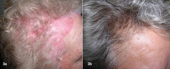 Vảy nến da đầu: Một liệu pháp tự nhiên đầy hứa hẹn - ảnh 1
