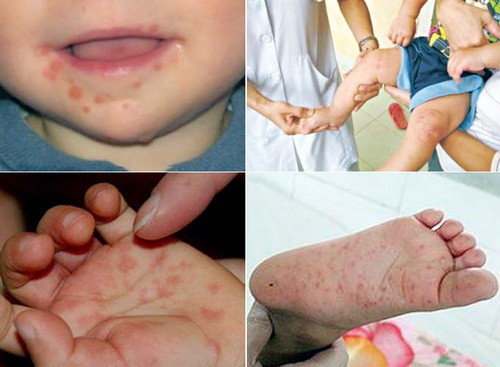Vắc-xin phòng bệnh tay chân miệng: Có hay chưa? - ảnh 1