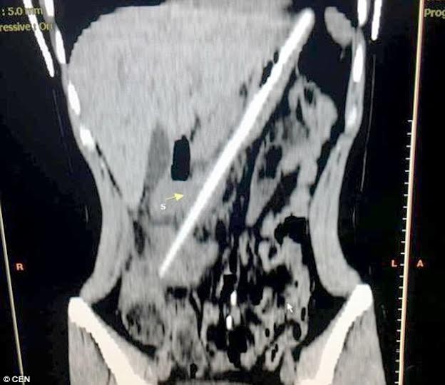 Cô gái 'nuôi' đũa dài 24cm trong bụng suốt ba tháng - ảnh 2