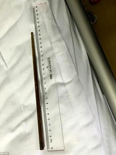 Cô gái 'nuôi' đũa dài 24cm trong bụng suốt ba tháng - ảnh 1