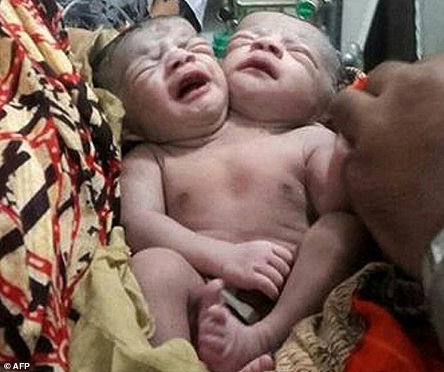 Bé sơ sinh hai đầu chào đời tại Bangladest - ảnh 1