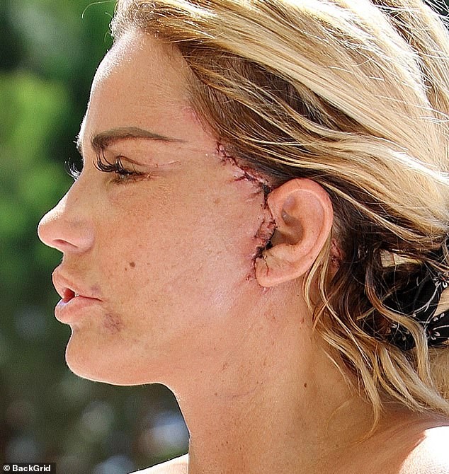 Katie Price mang mặt sẹo, bó căng ngực đi bơi hậu ‘đại tu’ ngoại hình - ảnh 2