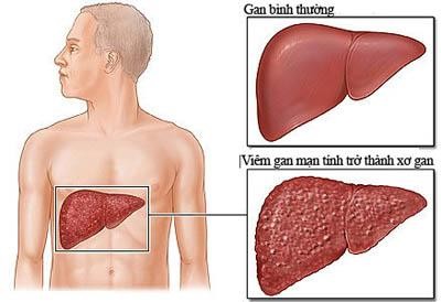 Dấu hiệu báo bệnh ung thư trước 2-5 năm - ảnh 1
