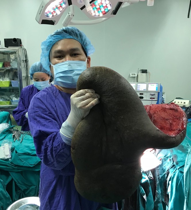 Cắt khối u khổng lồ... 15kg trên lưng nam bệnh nhân - ảnh 2