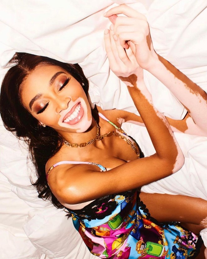 Siêu mẫu bạch biến Winnie Harlow khoe chân dài, dáng tạc tượng - ảnh 10