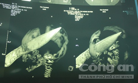 Những tình tiết rúng động vụ bé sơ sinh bị đâm xuyên sọ - ảnh 2