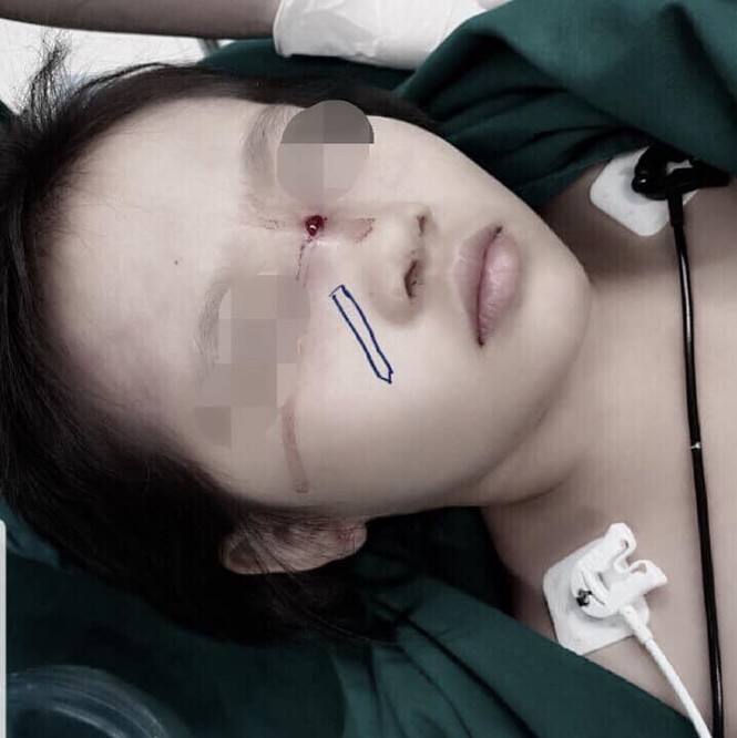 Bút chì cắm vào mắt lệch 1mm, bé gái thoát chết thần kì - ảnh 3