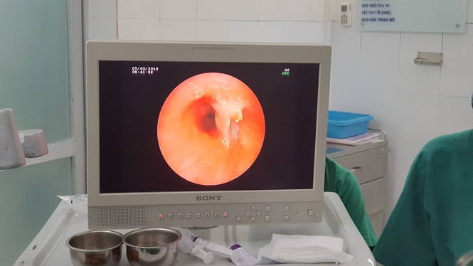 Gắp thành công xương cá kẹt trong đường thở bệnh nhân suốt 3 năm - ảnh 2