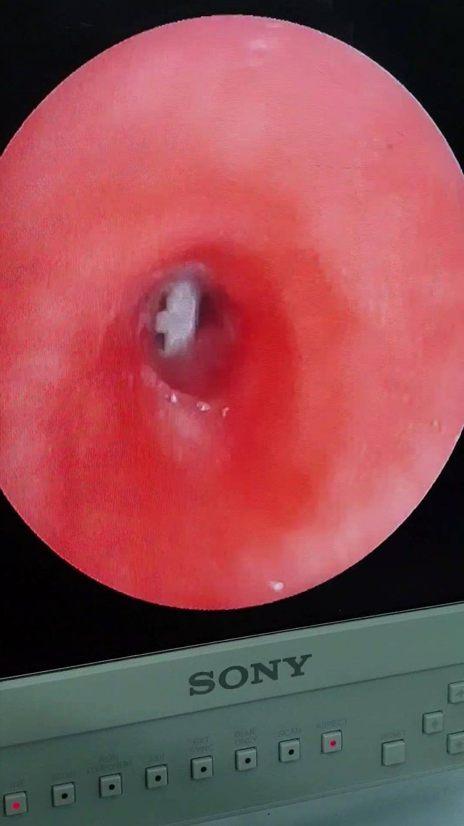 Bé trai 8 tuổi suýt chết vì nuốt phải món đồ chơi mà nhà nào cũng có - ảnh 2