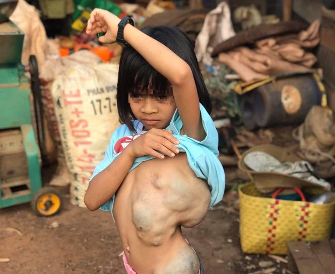 Phẫu thuật thành công cho bé gái dân tộc 8 năm cõng khối bướu trên lưng - ảnh 1