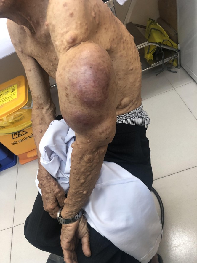 Cứu thầy giáo thoát cảnh mặc quần 'mỗi ống 1 size' vì khối bướu khổng lồ - ảnh 2