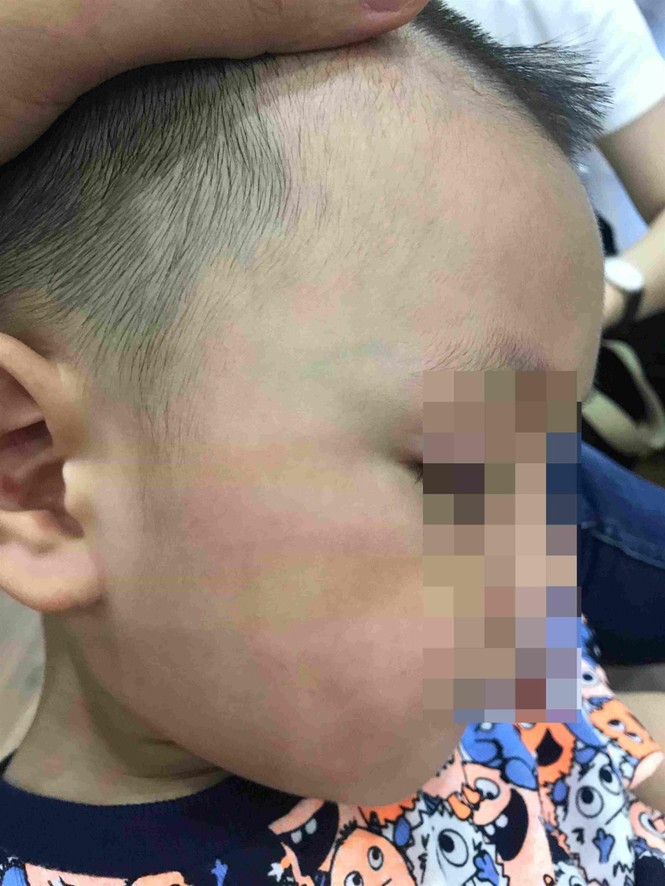 Cô giáo ở Hà Nội tát trẻ bầm dập, tụ máu môi - ảnh 1