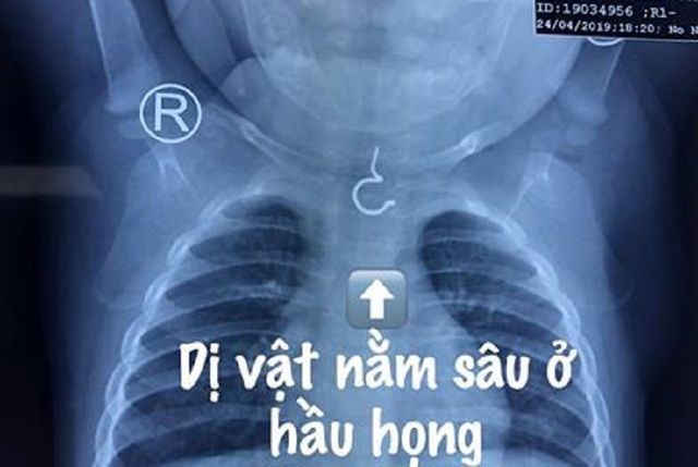 Bé gái nhập viện khi giật khuyên tai bằng vàng của bạn để... nuốt - ảnh 1