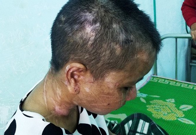 Hàng trăm vết thường từ đầu đến chân chị Y Nhiêu
