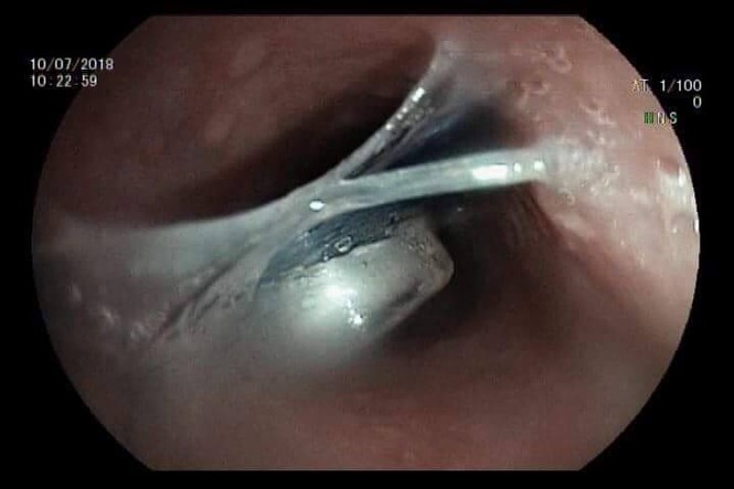 Dùng cơm chữa hóc dị vật ở cổ, người phụ nữ suýt mất mạng - ảnh 1