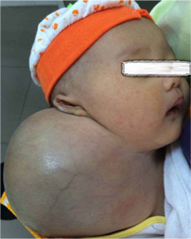 Điều trị tan u phì đại bằng tiêm thuốc - ảnh 1