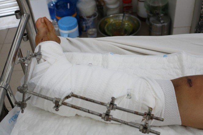 Cứu bé gái 15 tuổi khỏi tàn phế sau khi dập nát chân vì tai nạn - ảnh 1