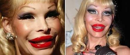 Amanda Lepore là một người đẹp chuyển giới nổi tiếng, tuy nhiên, do nghiện thẩm mỹ nên gương mặt cô đã biến dạng khiếp sợ như thế này