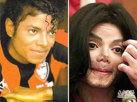 Cố ca sĩ Michael Jackson từng là nạn nhân của việc nghiện thẩm mỹ. Anh từng sở hữu gương mặt điển trai, nhưng cuối đời, gương mặt ấy hoàn toàn biến dạng