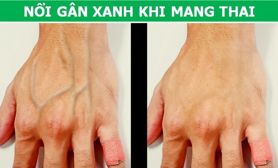Vì sao bạn “nổi gân xanh” trong khi người khác lại không - ảnh 3