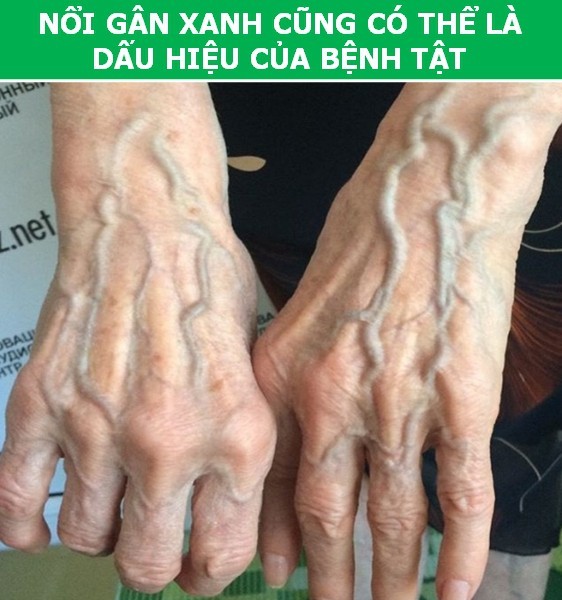 Vì sao bạn “nổi gân xanh” trong khi người khác lại không - ảnh 4