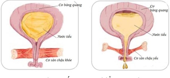 Tiểu són, tiểu nhiều lần, hội chứng bàng quang kích thích: Phải làm sao? - ảnh 1