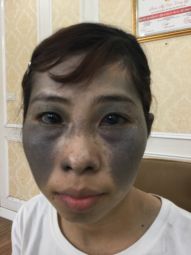 Bệnh viện thẩm mỹ Đông Á đồng hành cùng các hoàn cảnh khó khăn điều trị chàm bớt - ảnh 3