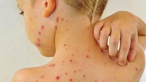Các bệnh ngoài da do virus và giải pháp hay từ sản phẩm cốm Subạc - ảnh 2