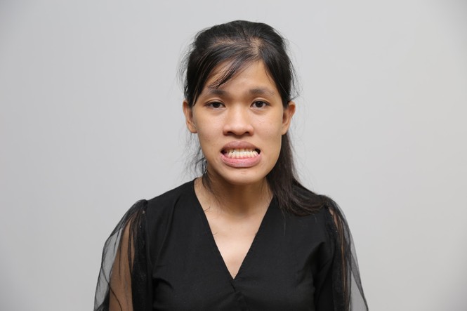 'Giải cứu' cô gái 23 tuổi mặt lệch khớp cắn, móm, biến dạng trục xương hàm - ảnh 1