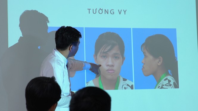 'Giải cứu' cô gái 23 tuổi mặt lệch khớp cắn, móm, biến dạng trục xương hàm - ảnh 2