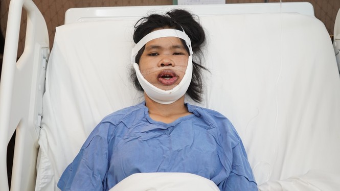 'Giải cứu' cô gái 23 tuổi mặt lệch khớp cắn, móm, biến dạng trục xương hàm - ảnh 3