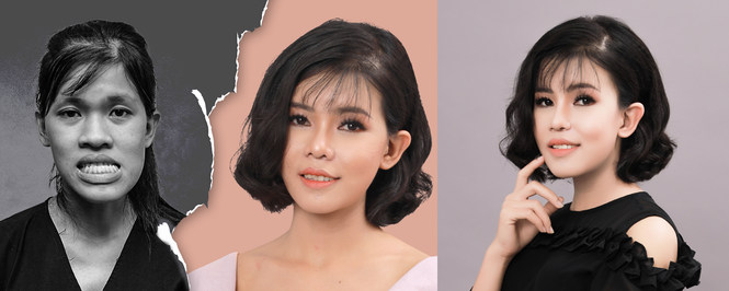 'Giải cứu' cô gái 23 tuổi mặt lệch khớp cắn, móm, biến dạng trục xương hàm - ảnh 4