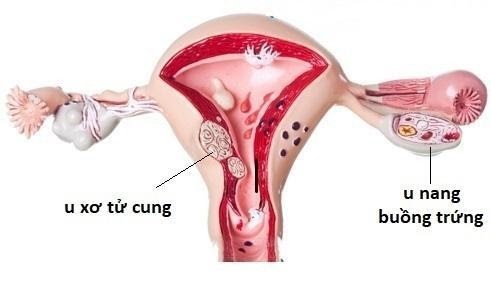 Những kiến thức cơ bản về bệnh u xơ tử cung, u nang buồng trứng - ảnh 1