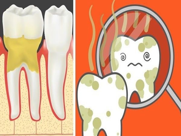 Bỏ túi ngay các mẹo hay trị hôi miệng - ảnh 1