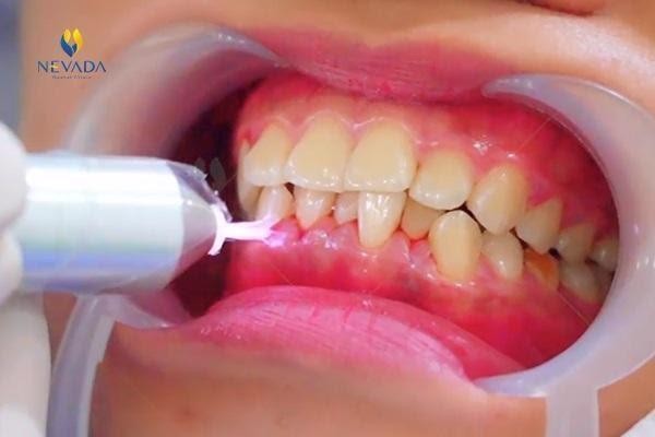 Superplas 6D – Đột phá trong giải pháp phục hình răng sứ thẩm mỹ siêu tương thích - ảnh 2