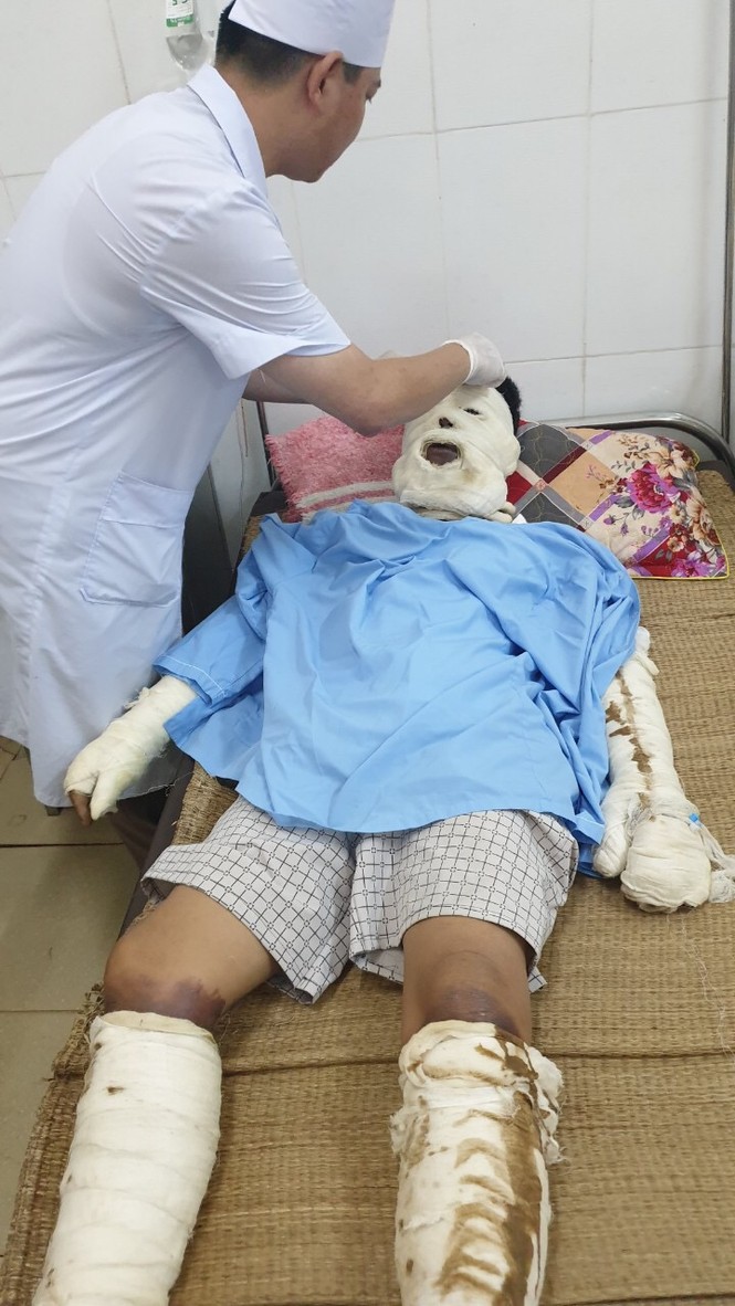 Phát nổ do rò rỉ khí ga trong đám tang, 5 người bỏng nặng - ảnh 1