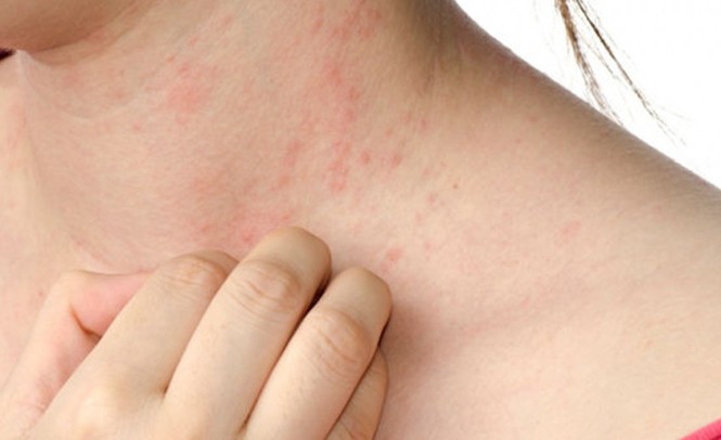 Bị dị ứng thế này khi trời lạnh có thể tử vong - ảnh 1