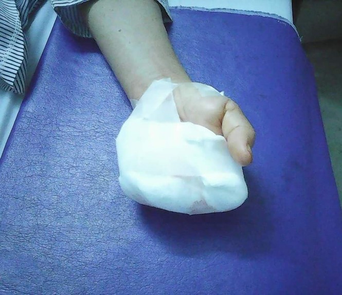 Máy xay thịt nghiền nát 4 ngón tay của một phụ nữ - ảnh 1