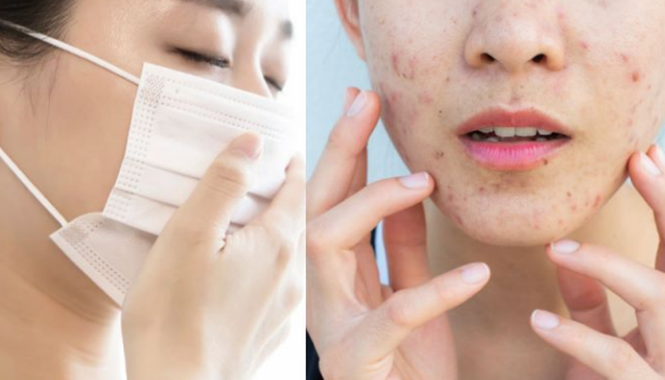 Đeo khẩu trang khiến mặt nhiều mụn hơn, phải giải quyết sao đây? - ảnh 1