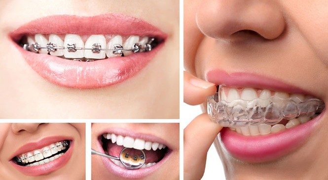 Ký sự niềng răng: Tớ đây vừa kết thúc hành trình