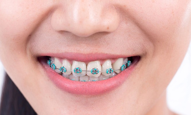 Ký sự niềng răng: Tớ đây vừa kết thúc hành trình