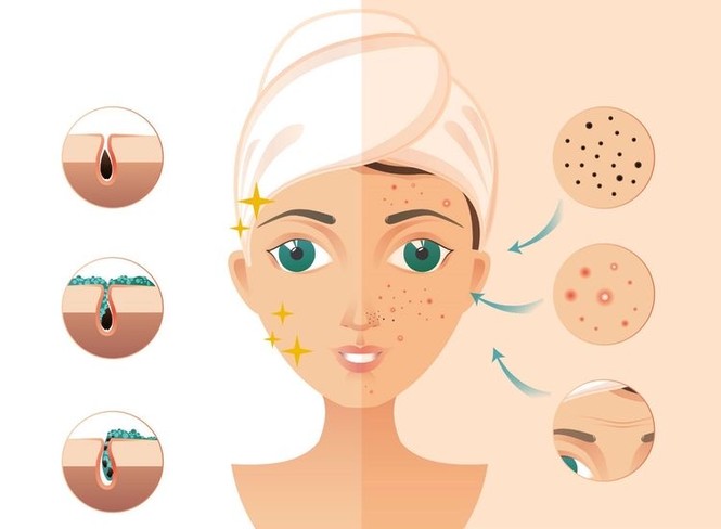Người mà em yêu em còn chia tay được, mụn đã là gì, cho dù là mụn-mùa-nóng cũng bye bye nha - ảnh 2