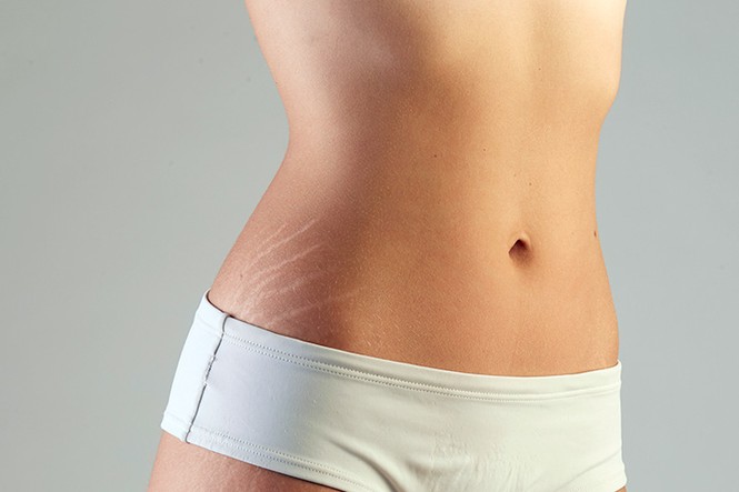 Không chỉ các mẹ bỉm sữa, teen cũng đau đầu với những vết rạn da! - ảnh 1
