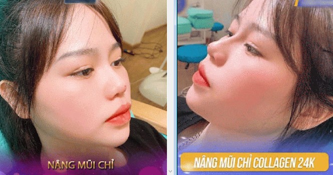 Bạn gái Quang Hải lên tiếng khi dân mạng truyền nhau ảnh cô nàng đi nâng mũi và sửa mặt - ảnh 1