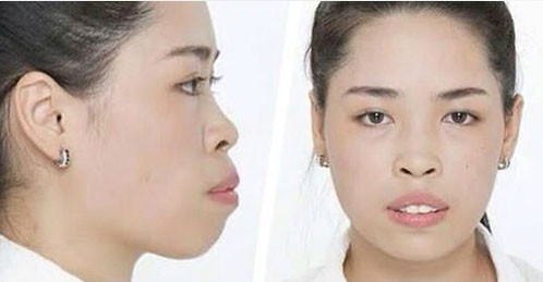 Cô gái 'răng vẩu' và cái kết bất ngờ sau thẩm mỹ - ảnh 1