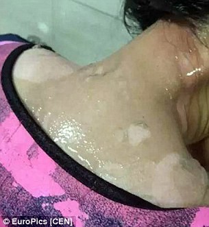 Cãi nhau với bồi bàn, cô gái bị dội nước sôi lên đầu - ảnh 1