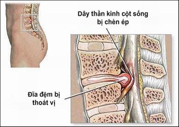 Đau lưng do thoát vị đĩa đệm - ảnh 1