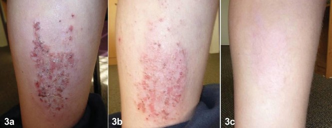 Điều trị viêm da cơ địa mạn tính bằng Dr Michaels Dermatinex thảo dược - ảnh 1